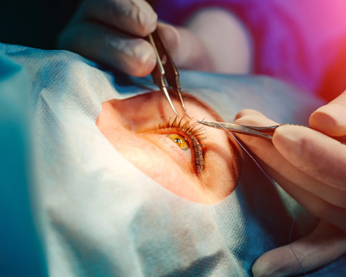 operation cataracte